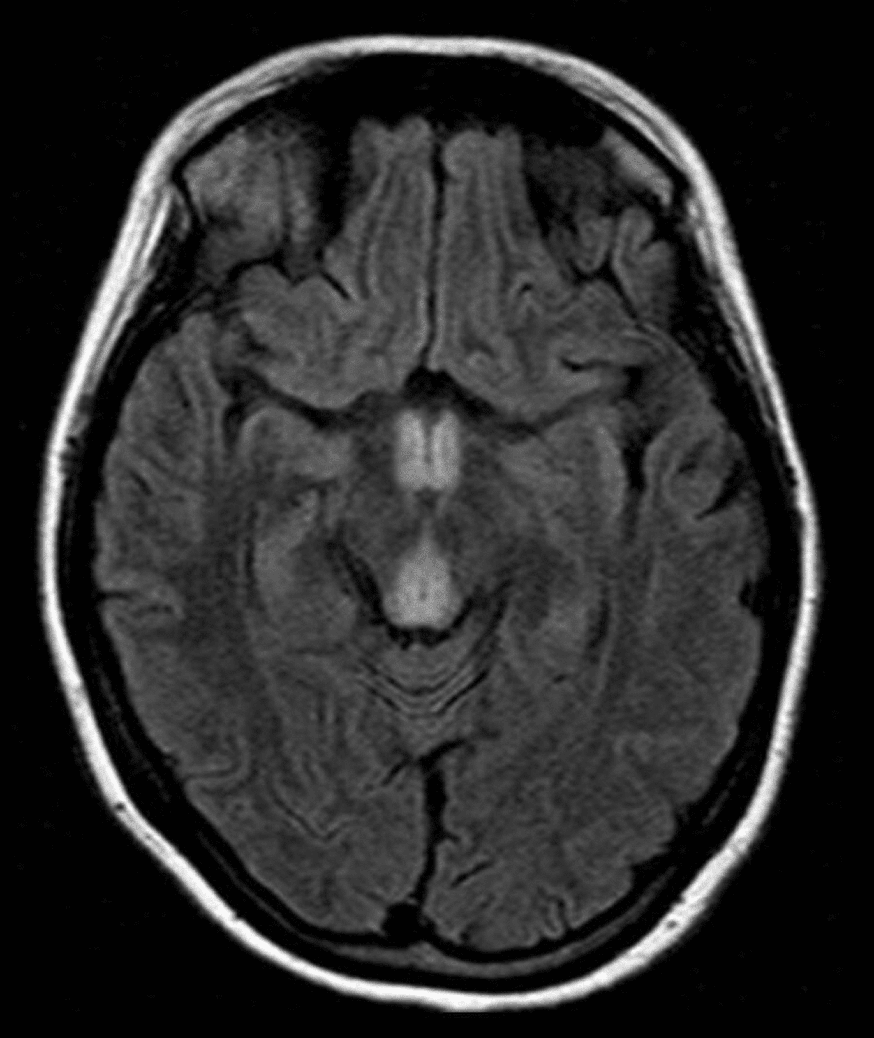 Cureus | Wernicke-Korsakoff Syndrome as a Consequence of Hyperemesis ...