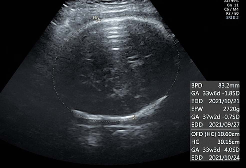 microcephaly ultrasound
