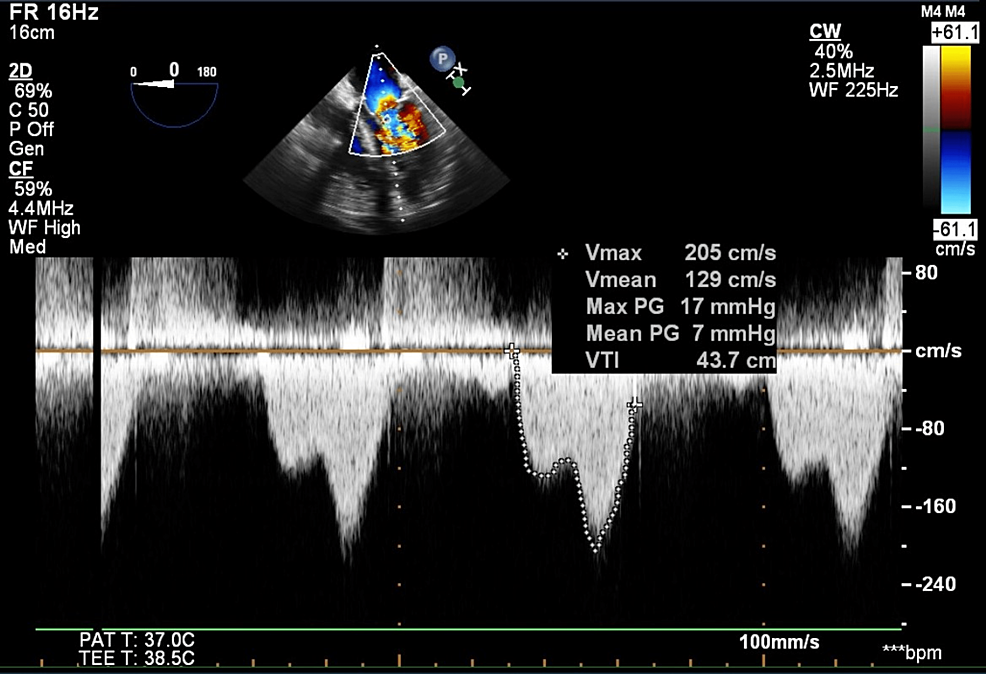 Anesthetic Considerations for Patients With Mitral Stenosis Undergoing ...