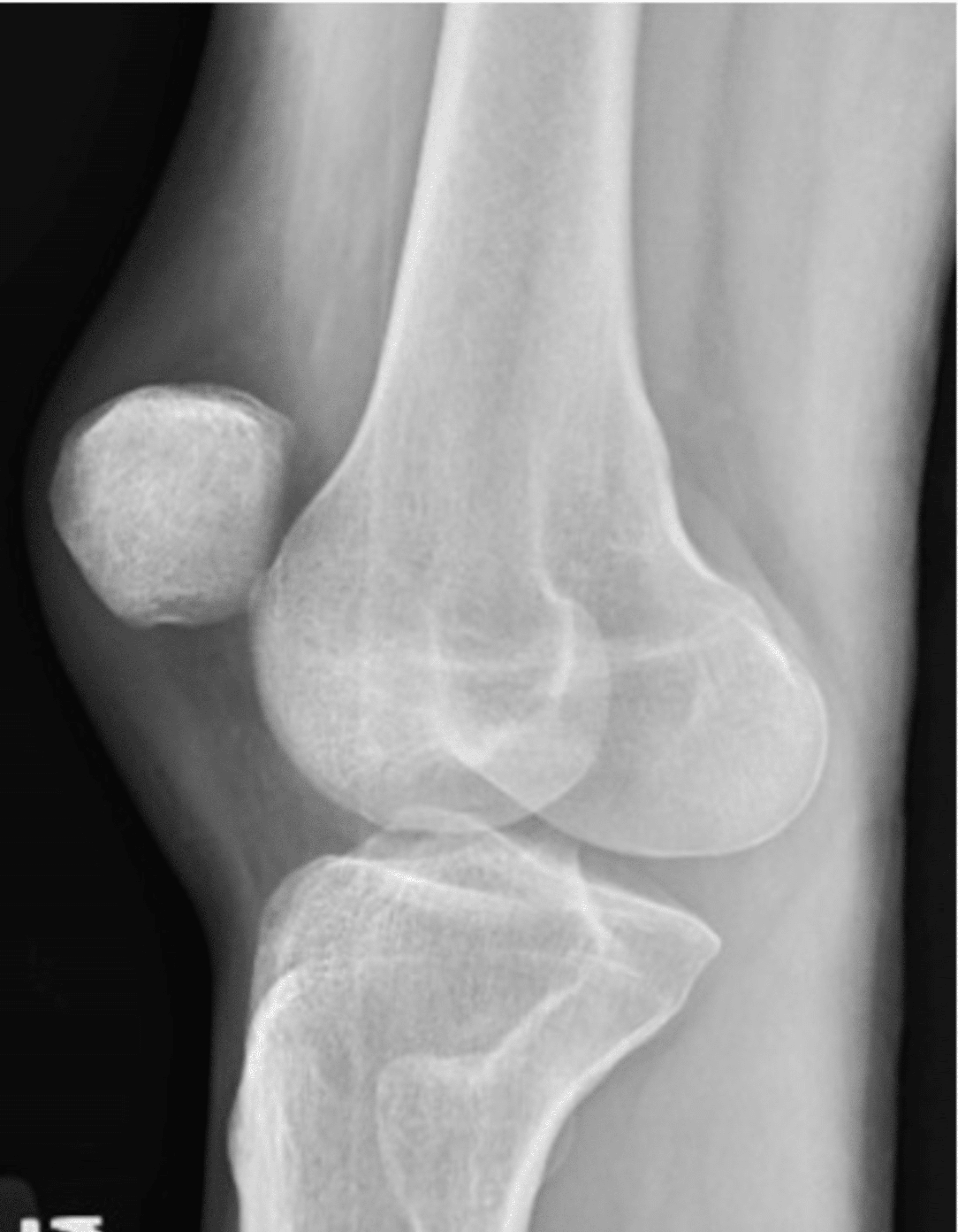 A Rare Case Of Vertical Patella Dislocation Reduced By Closed Reduction Cureus 1906