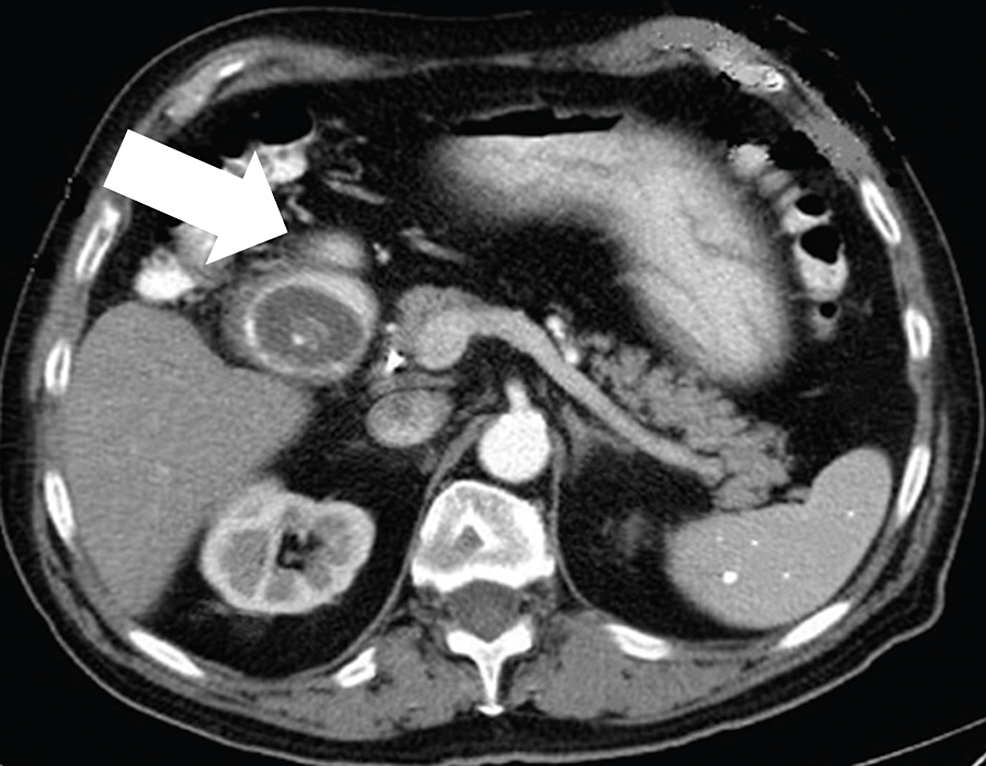Cureus Bouveret Syndrome A Rare Case of Gastric Outlet Obstruction