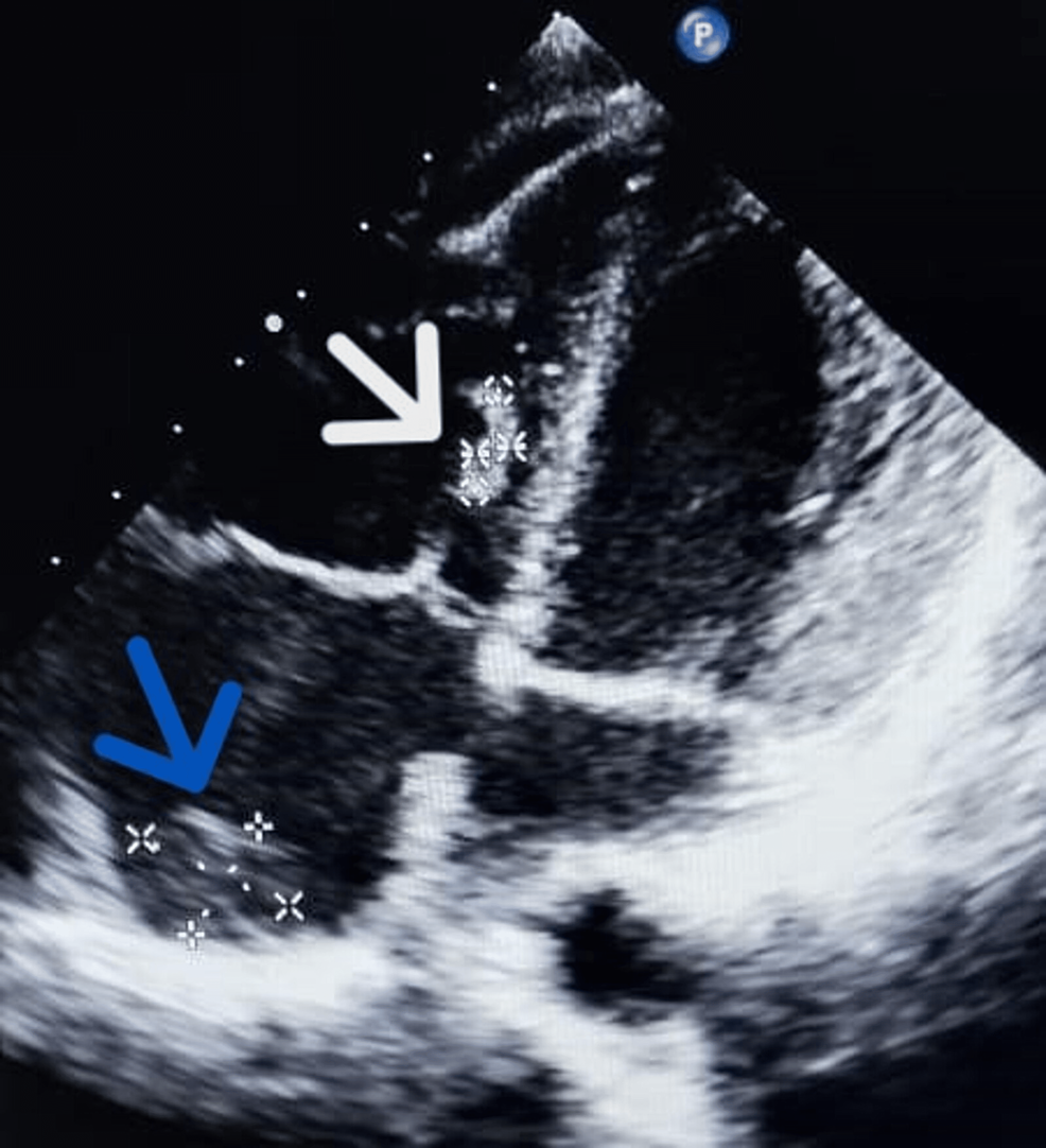 Transthoracic echocardiogram at admission and 6 mo follow up: global