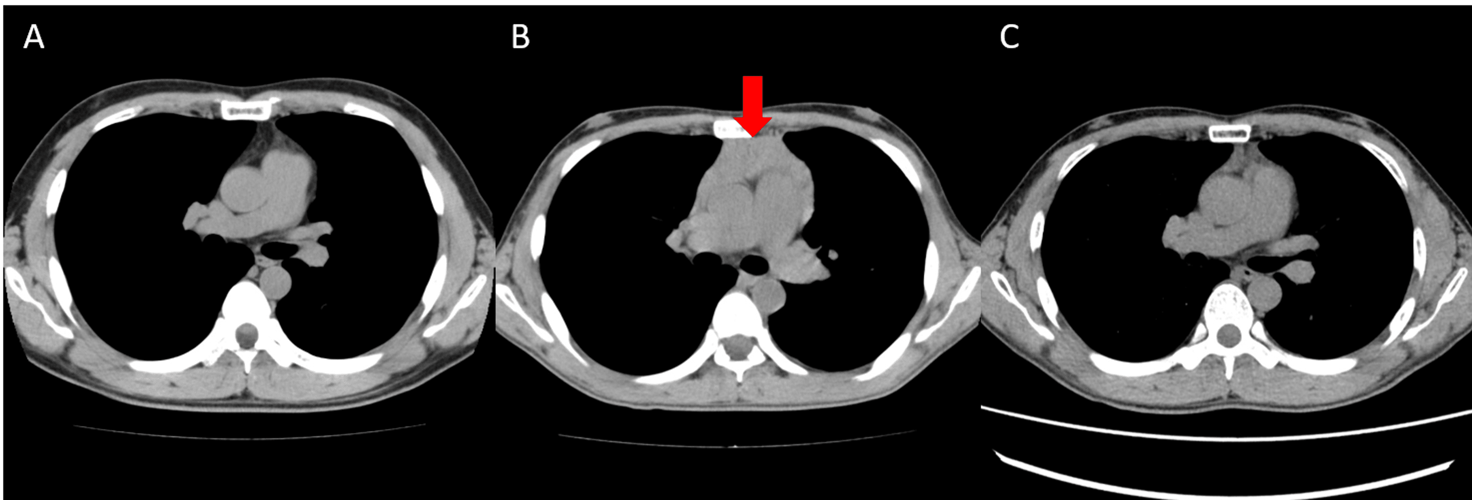 Progressive Thymic Hyperplasia With Graves’ Disease A Case Report Cureus