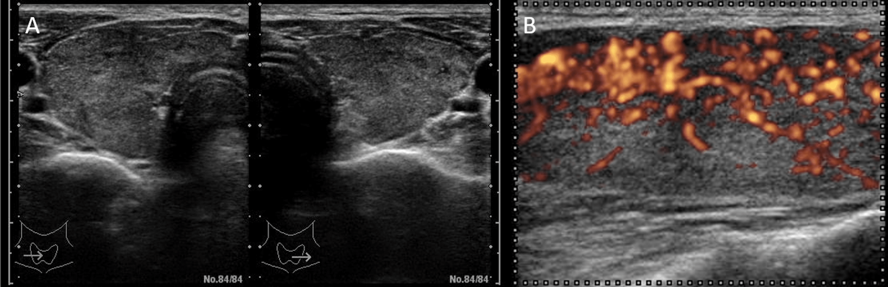 Progressive Thymic Hyperplasia With Graves’ Disease A Case Report Cureus