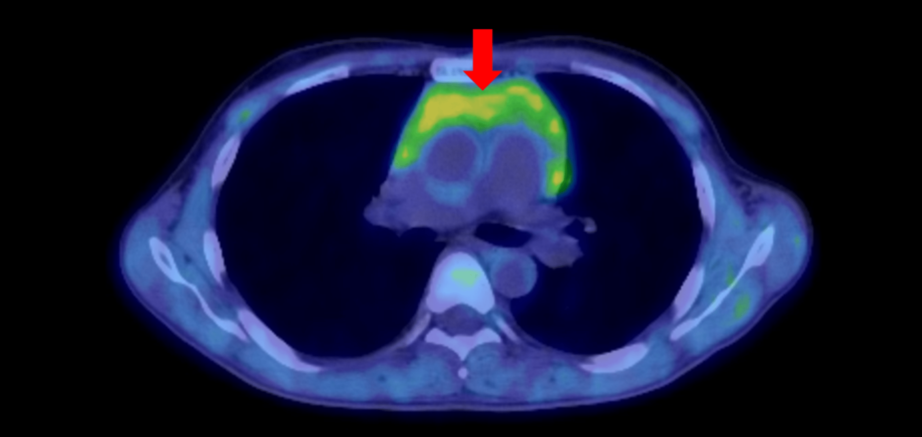 Progressive Thymic Hyperplasia With Graves’ Disease A Case Report Cureus