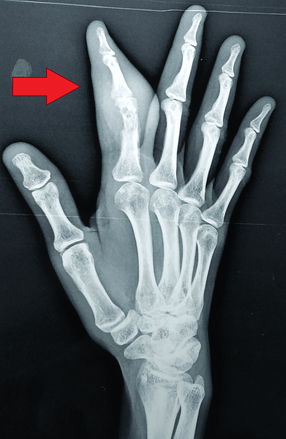 Spina Ventosa of the Right Index Finger in an Adult Indian Female With