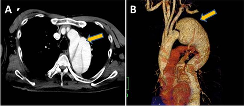 Cureus | Total Arch and Descending Aorta Replacement for Retrograde ...