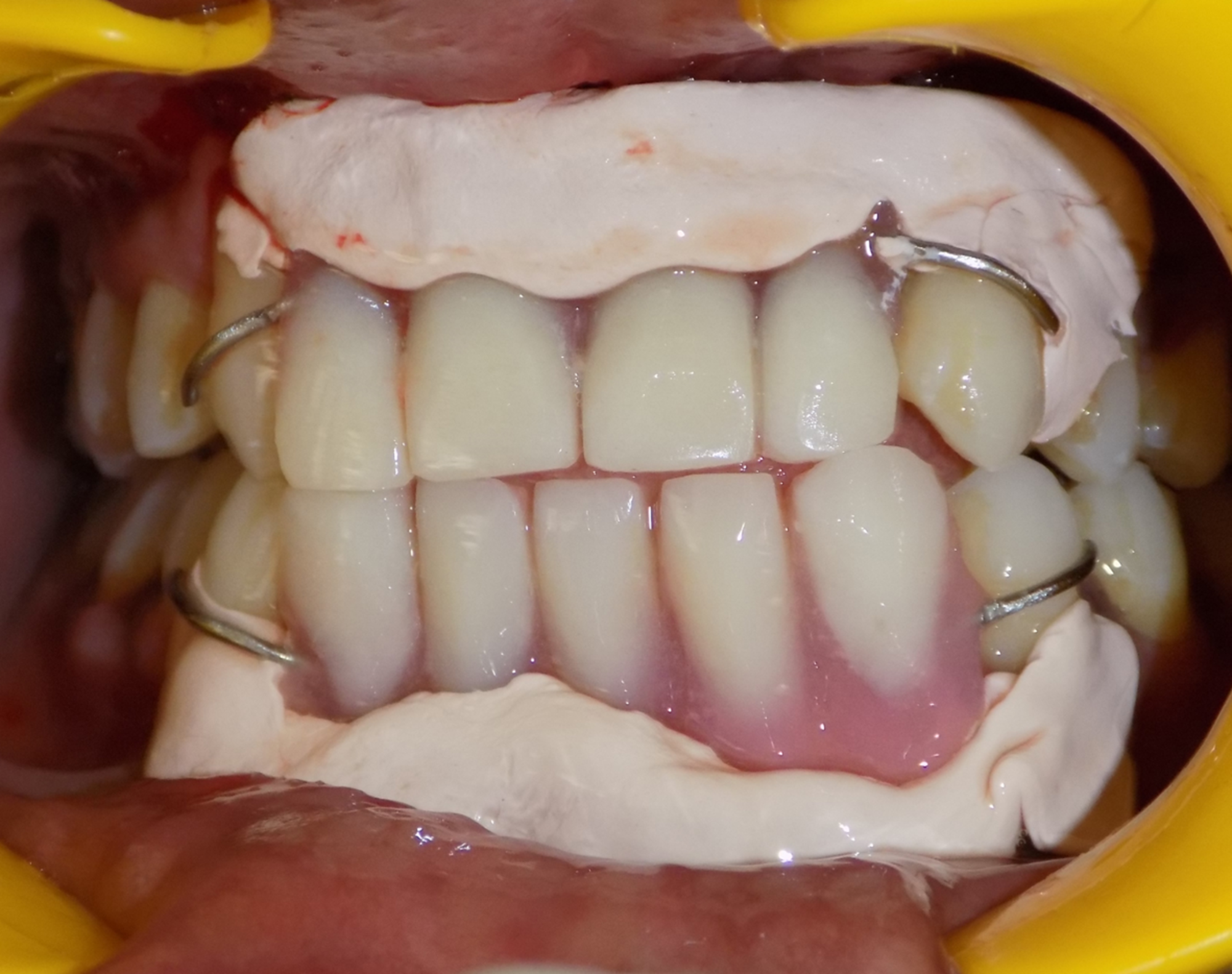 Cureus Management of Shallow Vestibule with Reduced Attached Gingiva