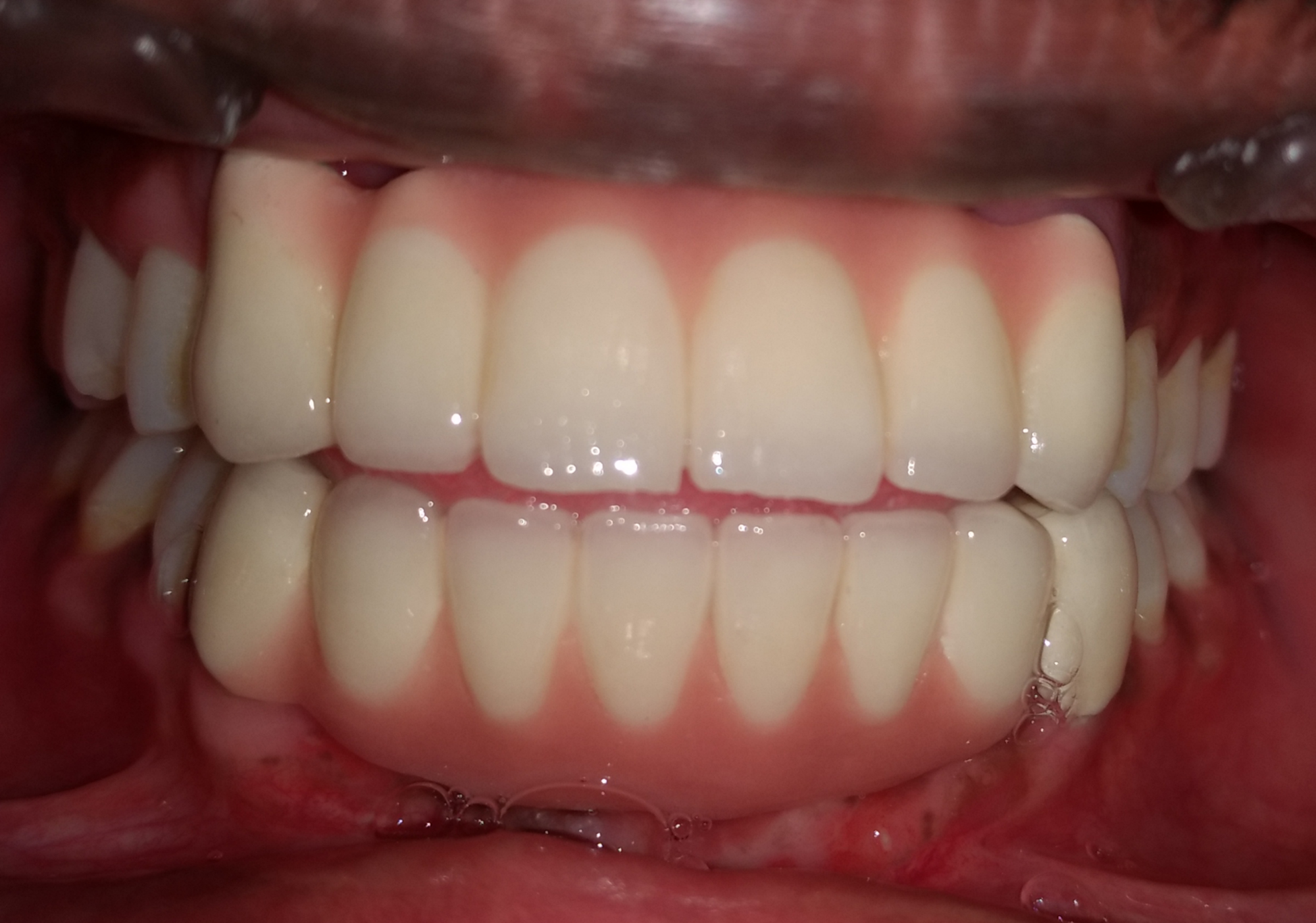 Cureus Management of Shallow Vestibule with Reduced Attached Gingiva