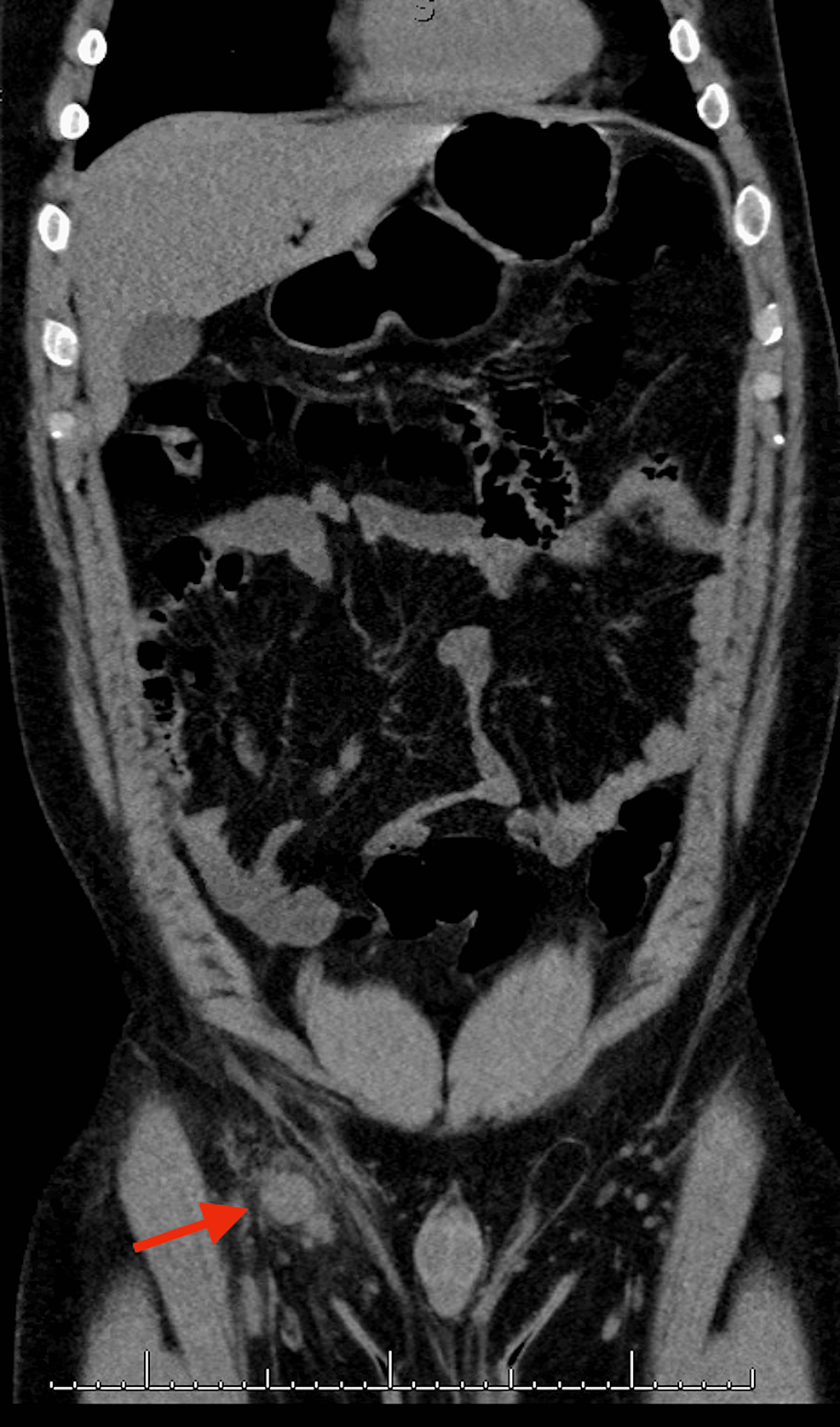 Cureus | Cat Scratch Disease: An Unusual Case of Right Inguinal ...