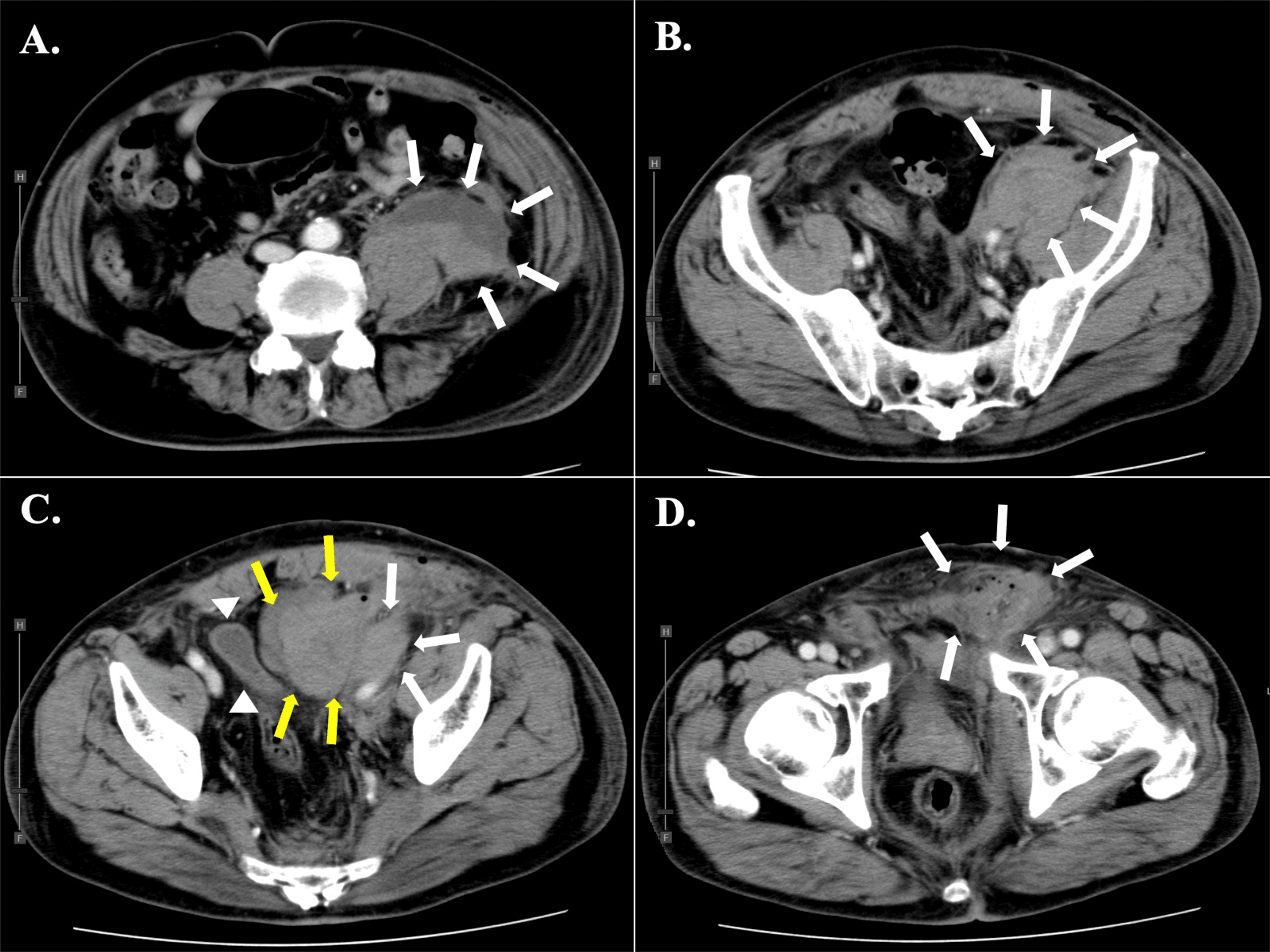 Hematoma After Inguinal Hernia Repair