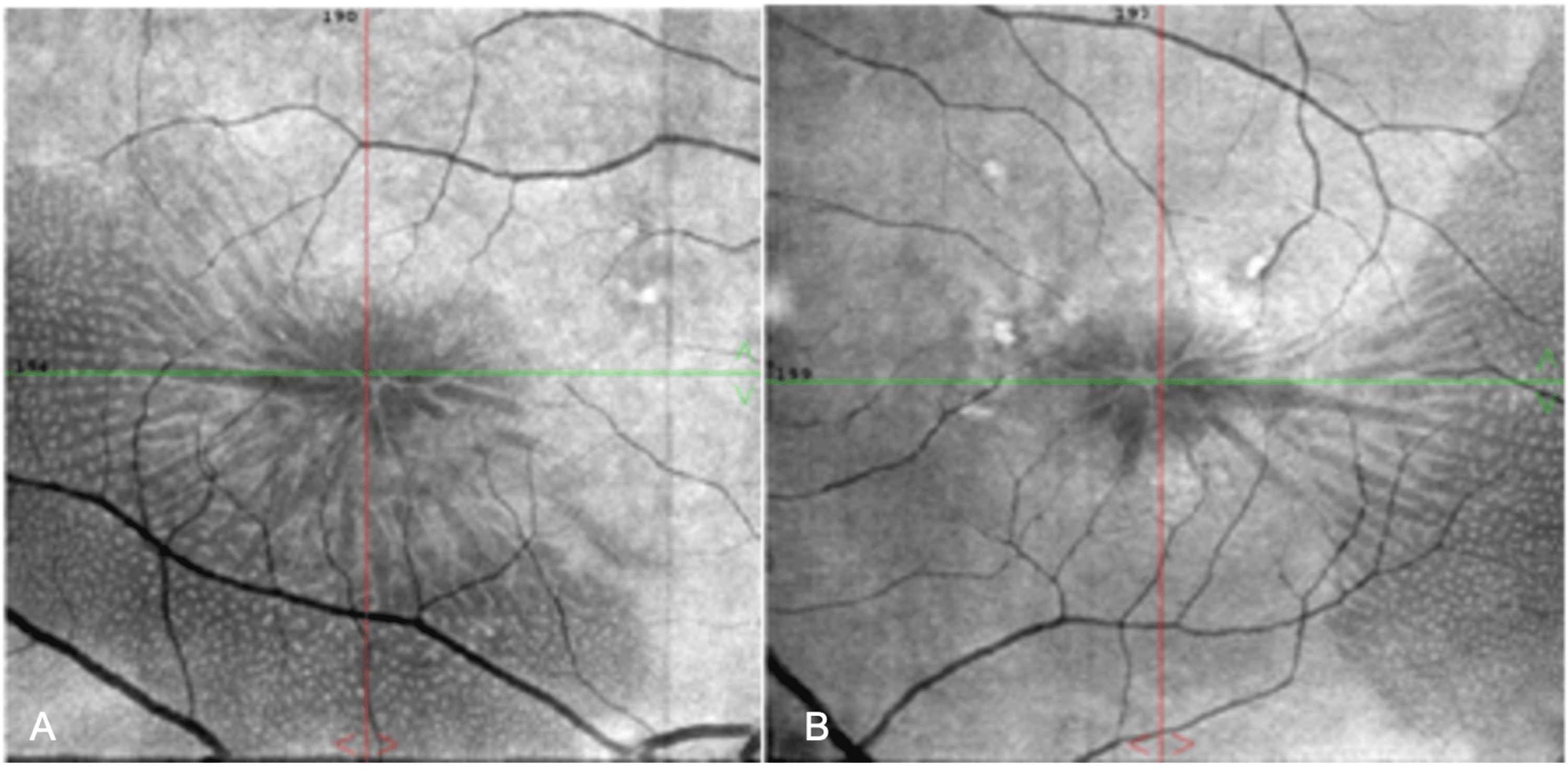 Cureus Bilateral Stellate Nonhereditary Idiopathic Foveomacular Retinoschisis (SNIFR