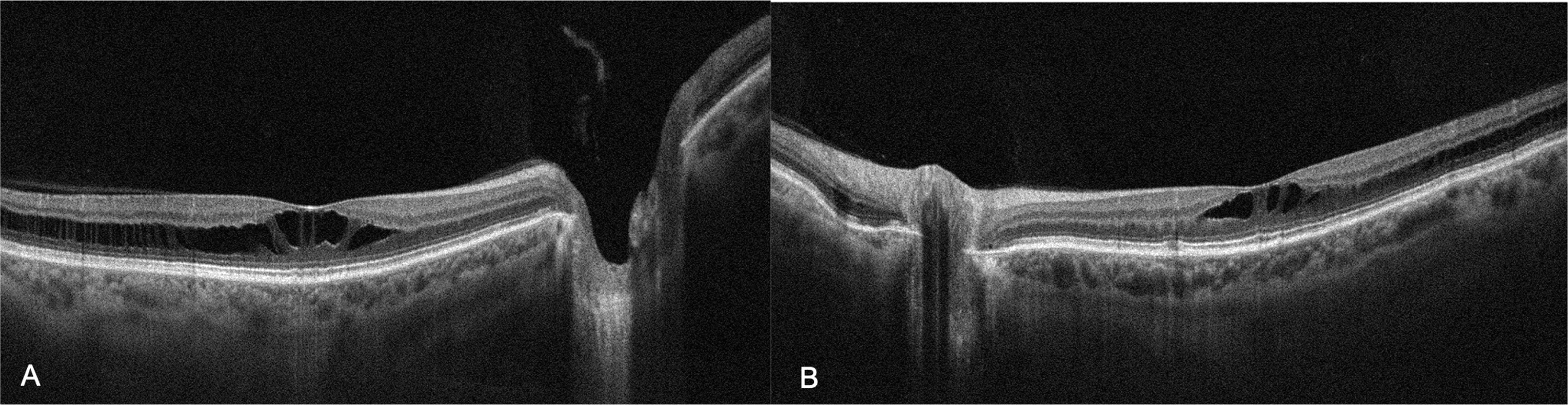 Cureus Bilateral Stellate Nonhereditary Idiopathic Foveomacular Retinoschisis (SNIFR