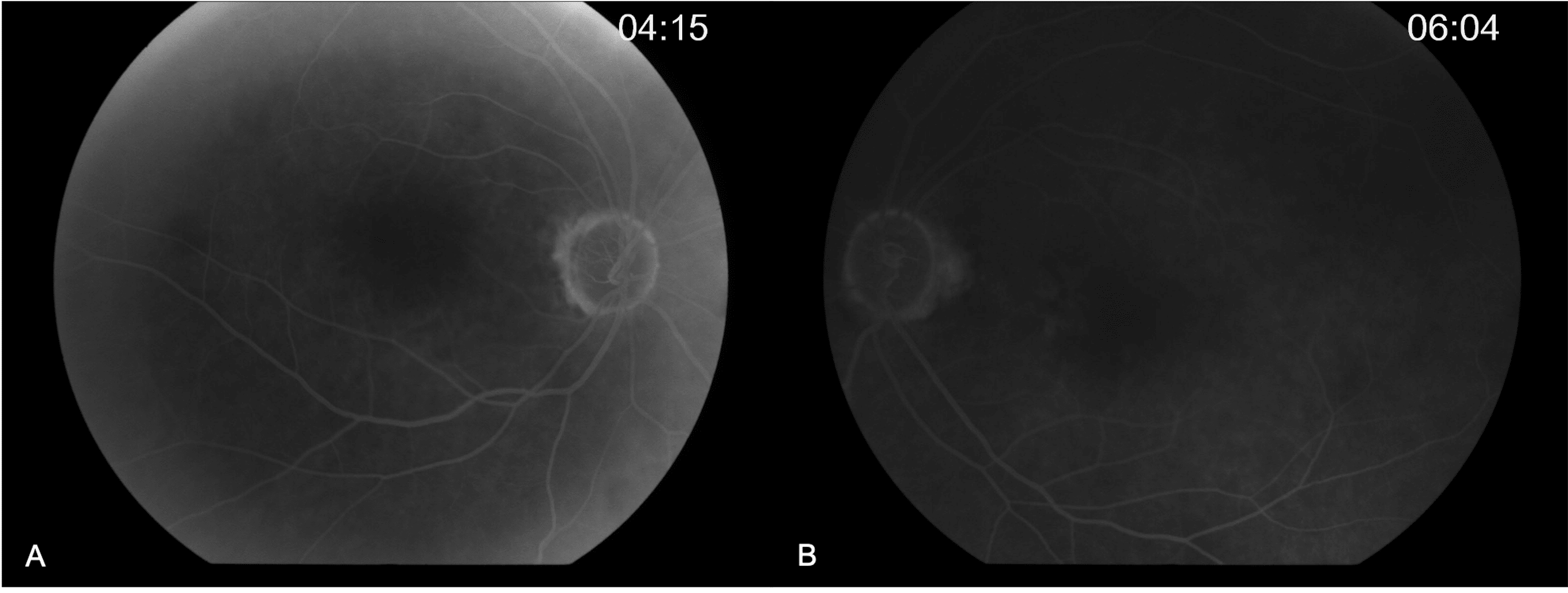 Cureus Bilateral Stellate Nonhereditary Idiopathic Foveomacular Retinoschisis (SNIFR