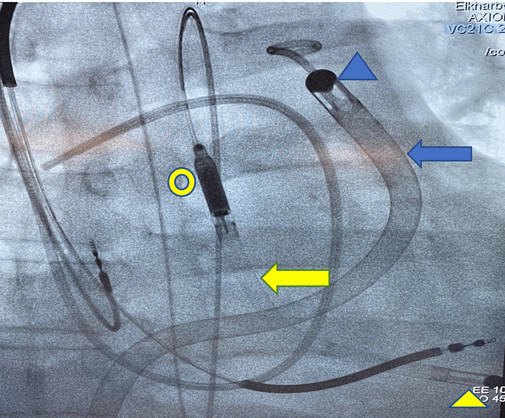 Cureus | Impella RP Use in Refractory Cardiogenic Shock in a Patient ...