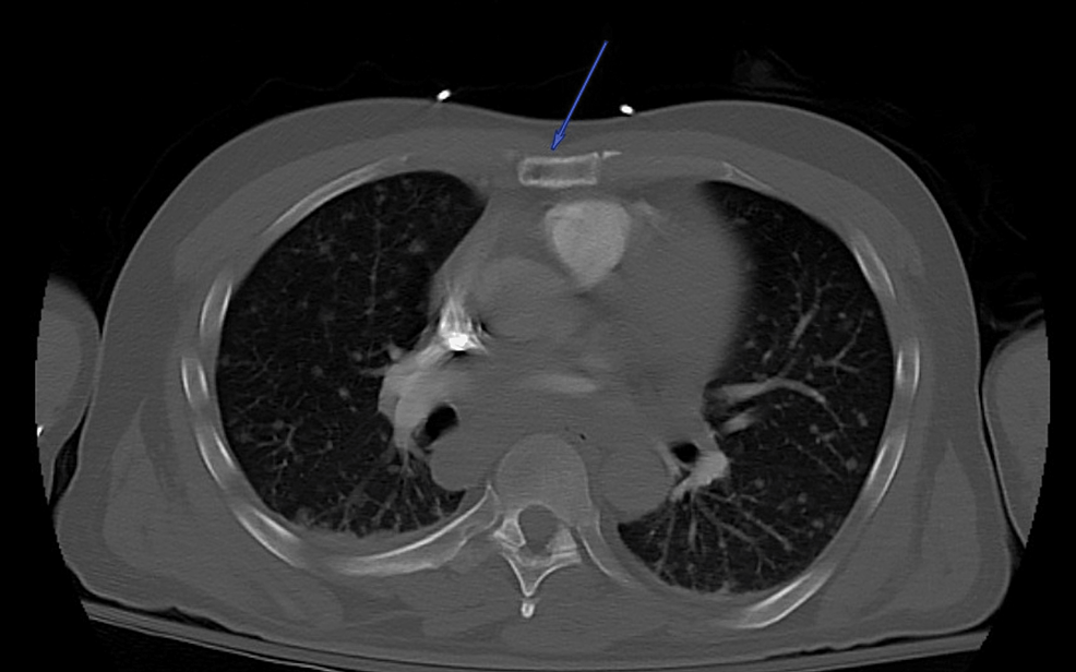 Sarcoidosis With Skeletal Involvement Masquerading As Metastatic Malignancy Cureus