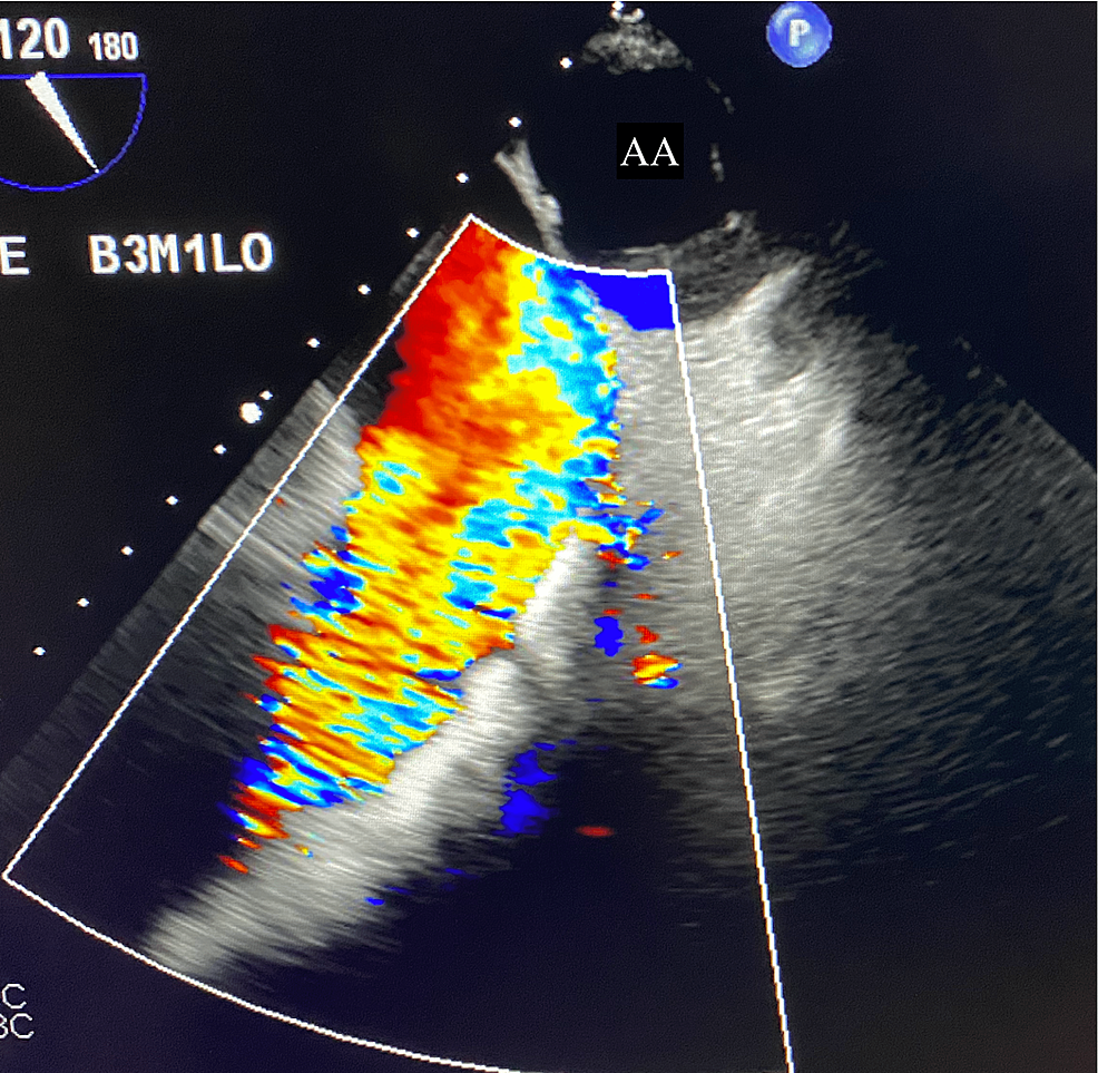 Management of Unrepaired Tetralogy of Fallot in an 86-Year-Old Patient ...