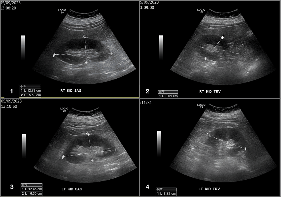 rhabdomyolysis glp 1 An Incidental Finding of a Glucagon-Like Peptide 1 (GLP-1)-Induced Acute  Kidney Injury: A Case Report