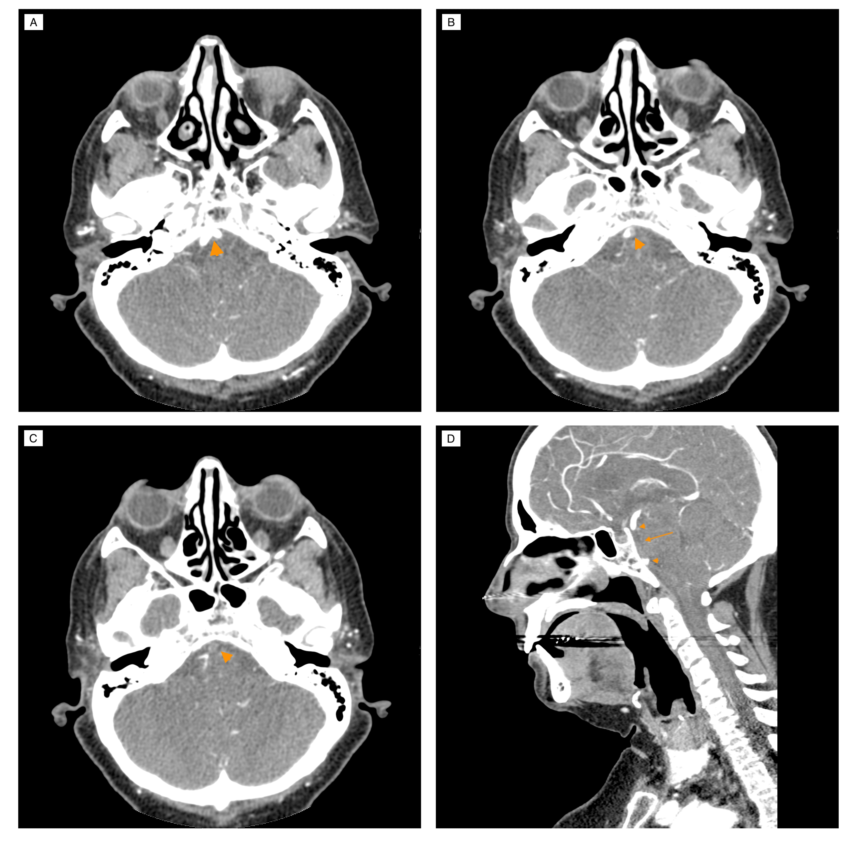 Cureus | From Dizziness and Hearing Loss to Coma: A Case of Basilar ...