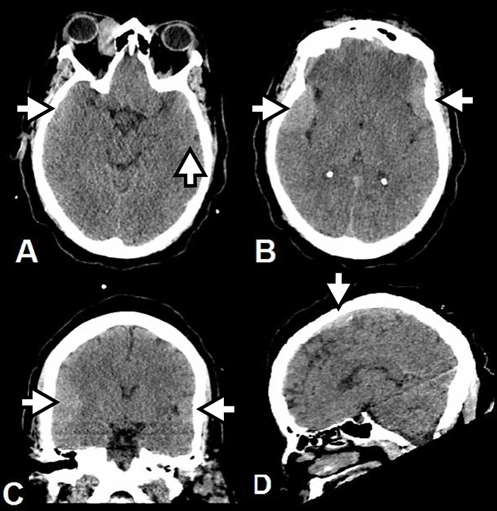 Multiple Intracranial Rosai-Dorfman Disease: A Case Report | Cureus