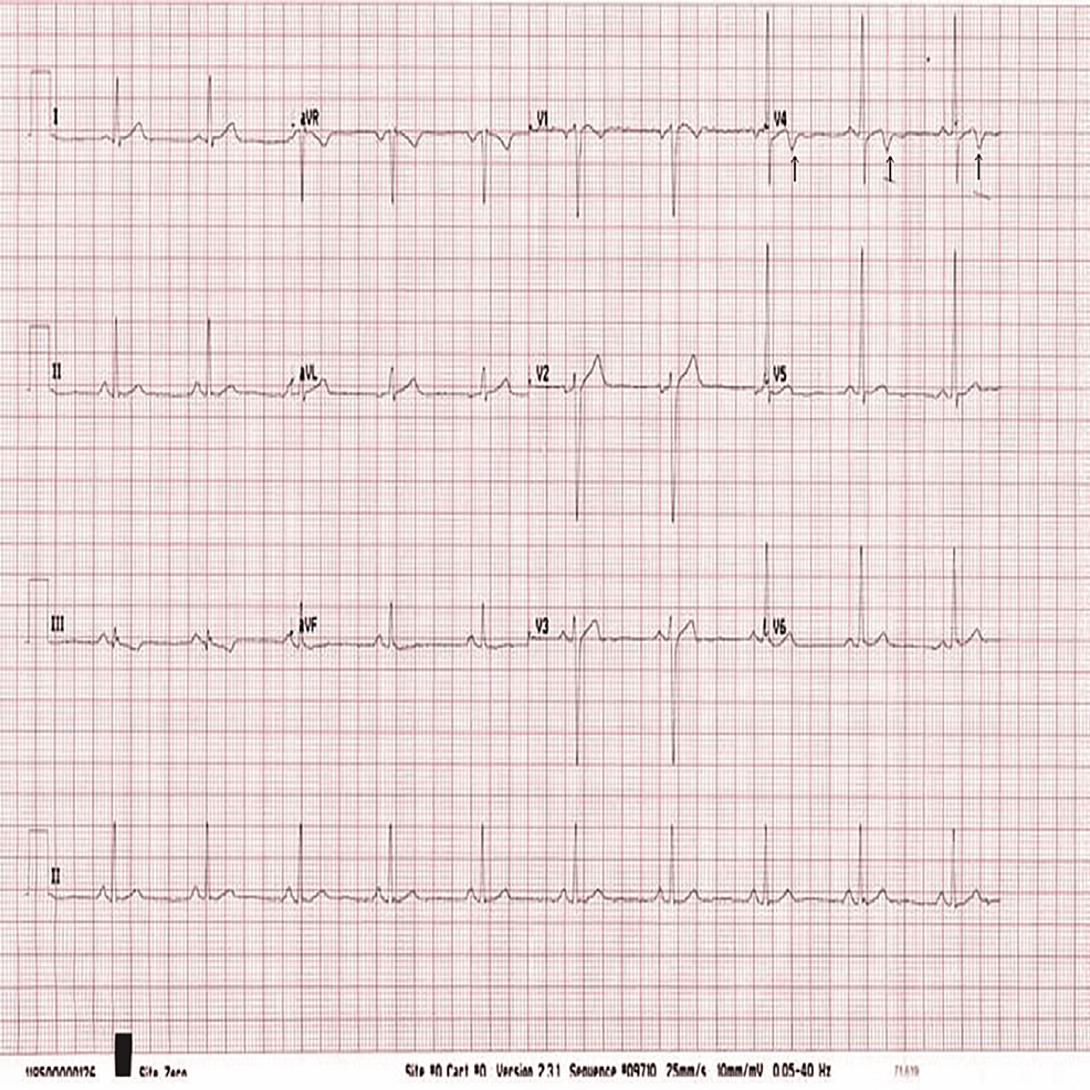 cureus-can-hot-weather-cause-non-st-elevation-myocardial-infarction