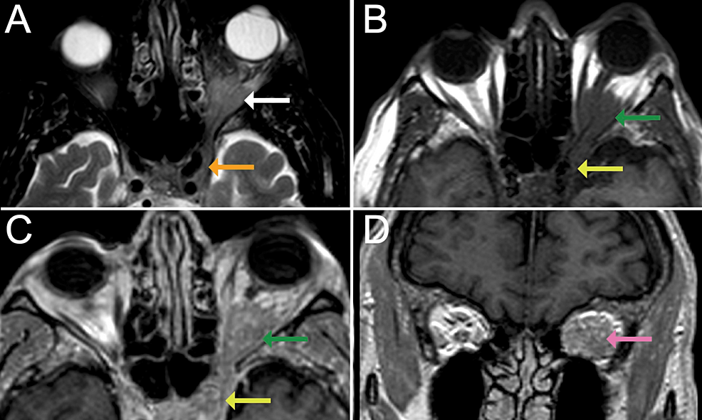 Cureus | Tolosa Hunt Syndrome: MRI Findings