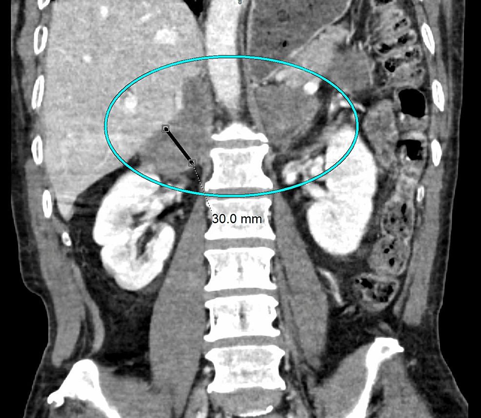 Unusual Presentation of Disseminated Histoplasmosis in an