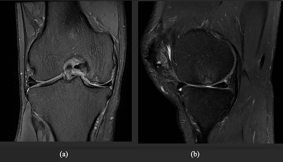 Patellar Cartilage Bossing Causing Patellofemoral Pain After Cartilage ...