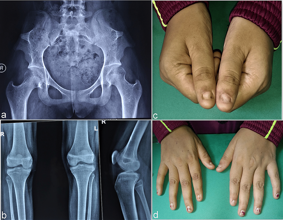 Cureus | “Knee-Ding” a Diagnosis: A Case of Nail Patella Syndrome