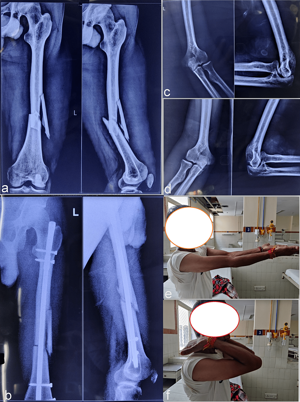 Cureus NailPatella Syndrome A Case Series From Northern India
