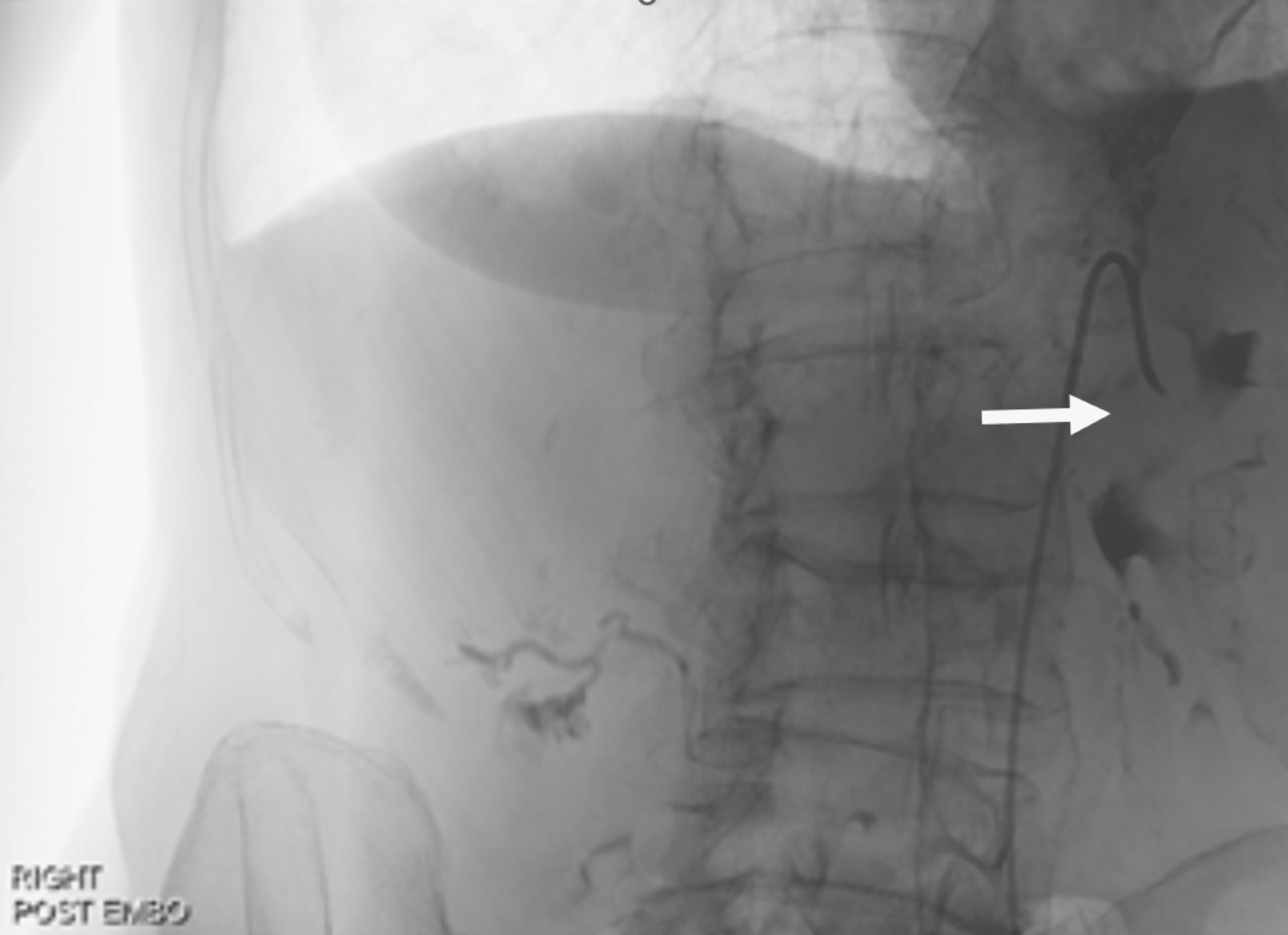 Cureus | Hepatic Artery Aneurysm/Pseudoaneurysm: An Unusual Cause of ...