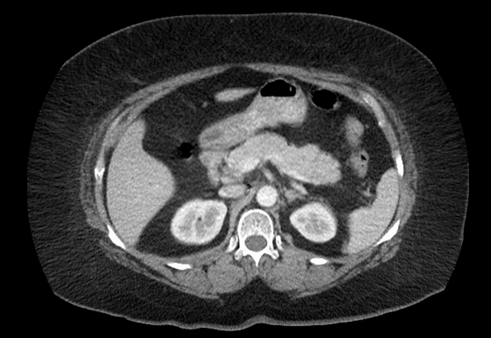 pancreatitis and semaglutide Acute Pancreatitis in a Patient Taking Semaglutide
