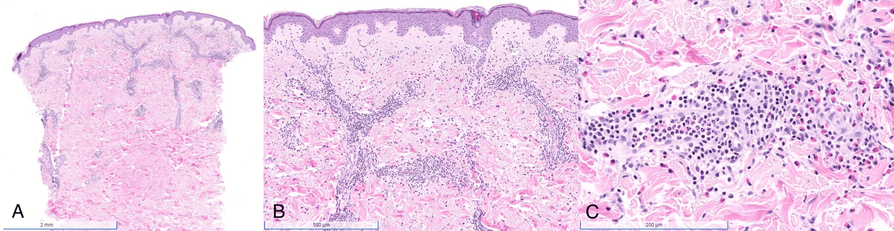 Cureus | Eosinophilic Annular Erythema Responding to Doxycycline