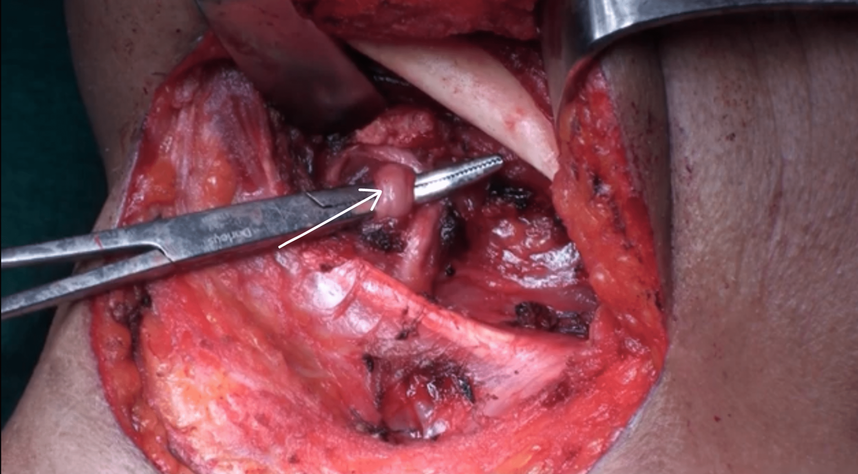 Cureus Harnessing the Triangles of the Neck for Lingual