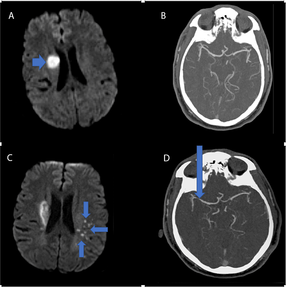 Reversible Cerebral Vasoconstriction Syndrome