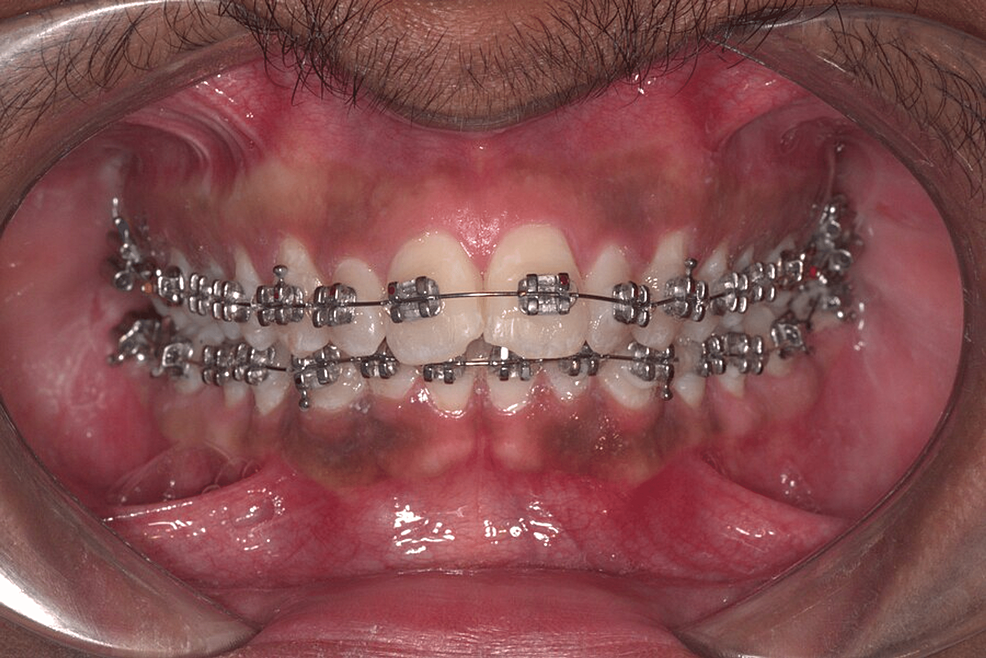Comparative Assessment of Bracket Bond Failure Rates of a Novel