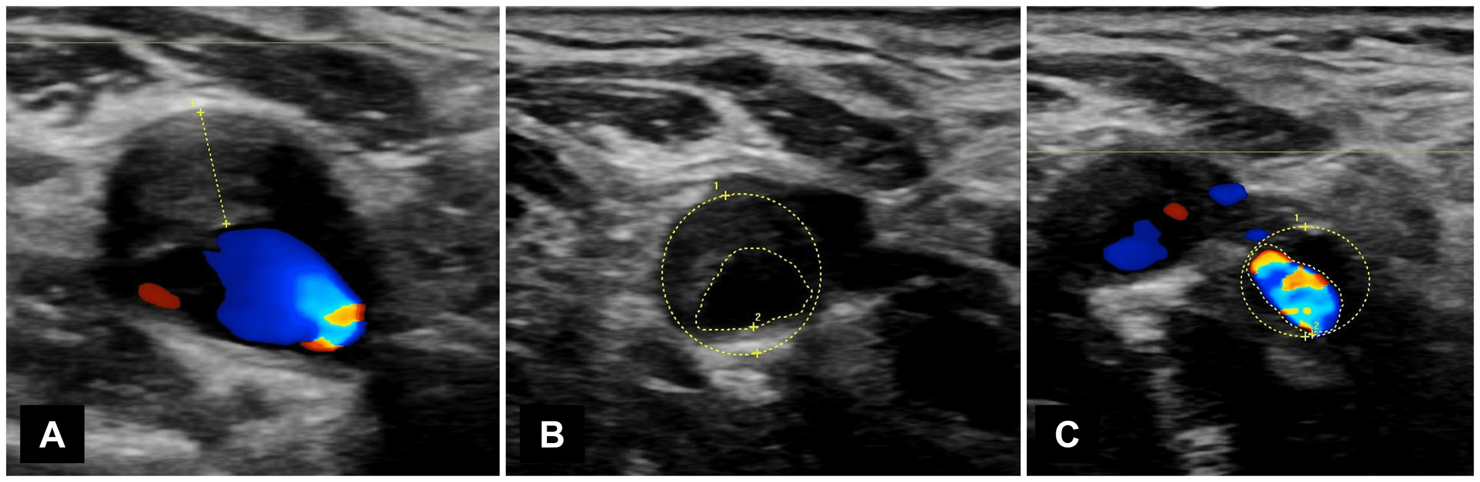 Cureus | Jaw Claudication Caused by Atherothrombotic External Carotid ...