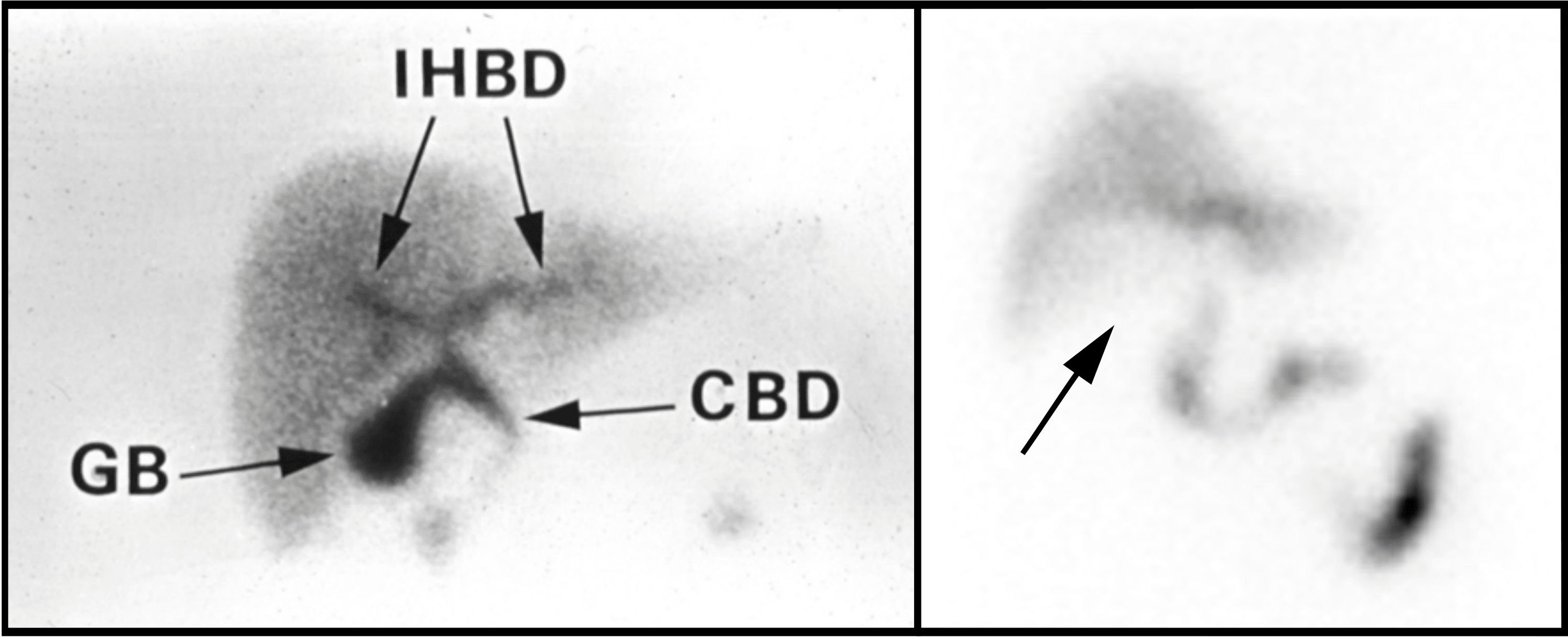 Successful Treatment of Xanthogranulomatous Cholecystitis Following