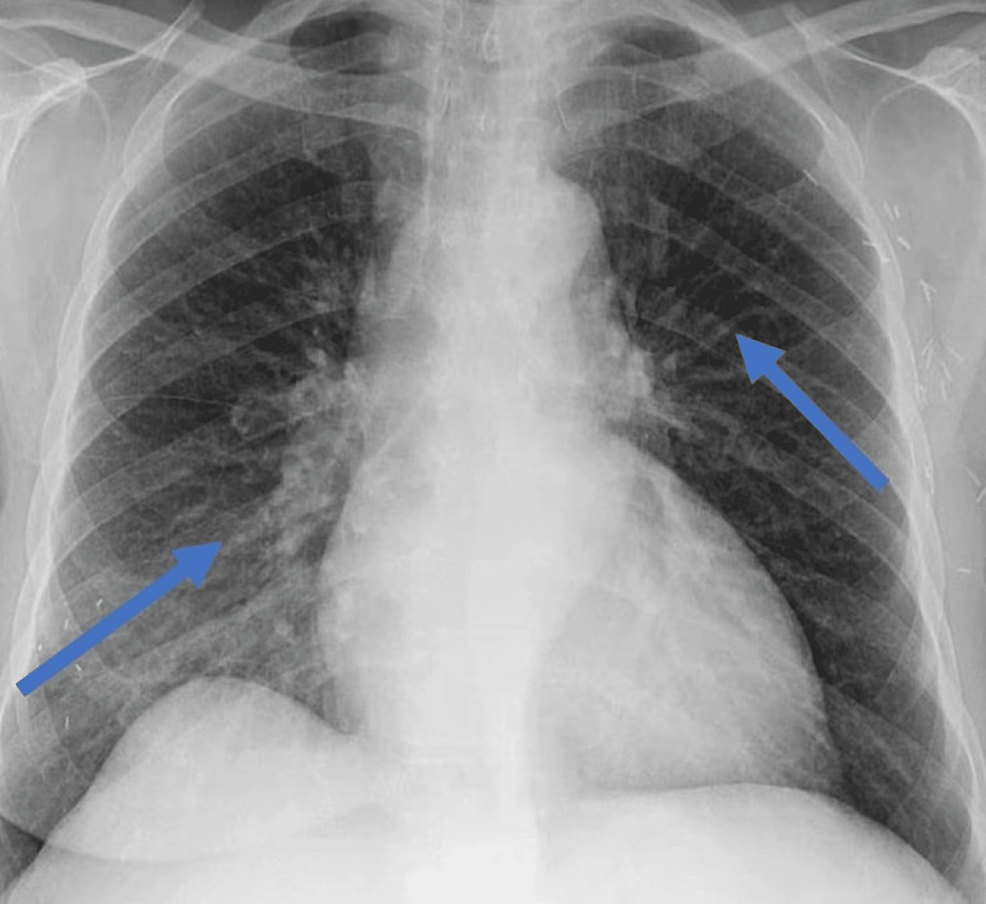 Chest-x-ray-showing-prominent-vascular-marking-suggestive-of-acute-pulmonary-edema-(blue-arrows).