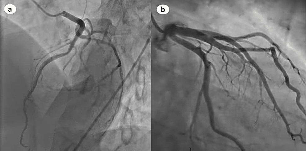 Coronary-angiography-showing-normal-right-(a)-and-left-(b)-coronary-arteries.