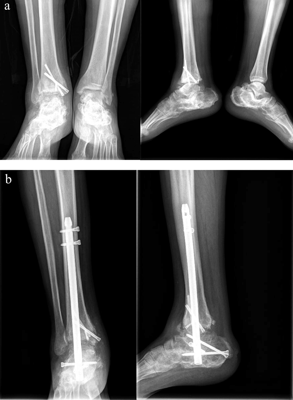 Calcaneotalotibial arthrodesis by retrograde intramedullary nailing using  expert tibia nail for charcot osteoneuropathy of the foot: A case series -  ScienceDirect