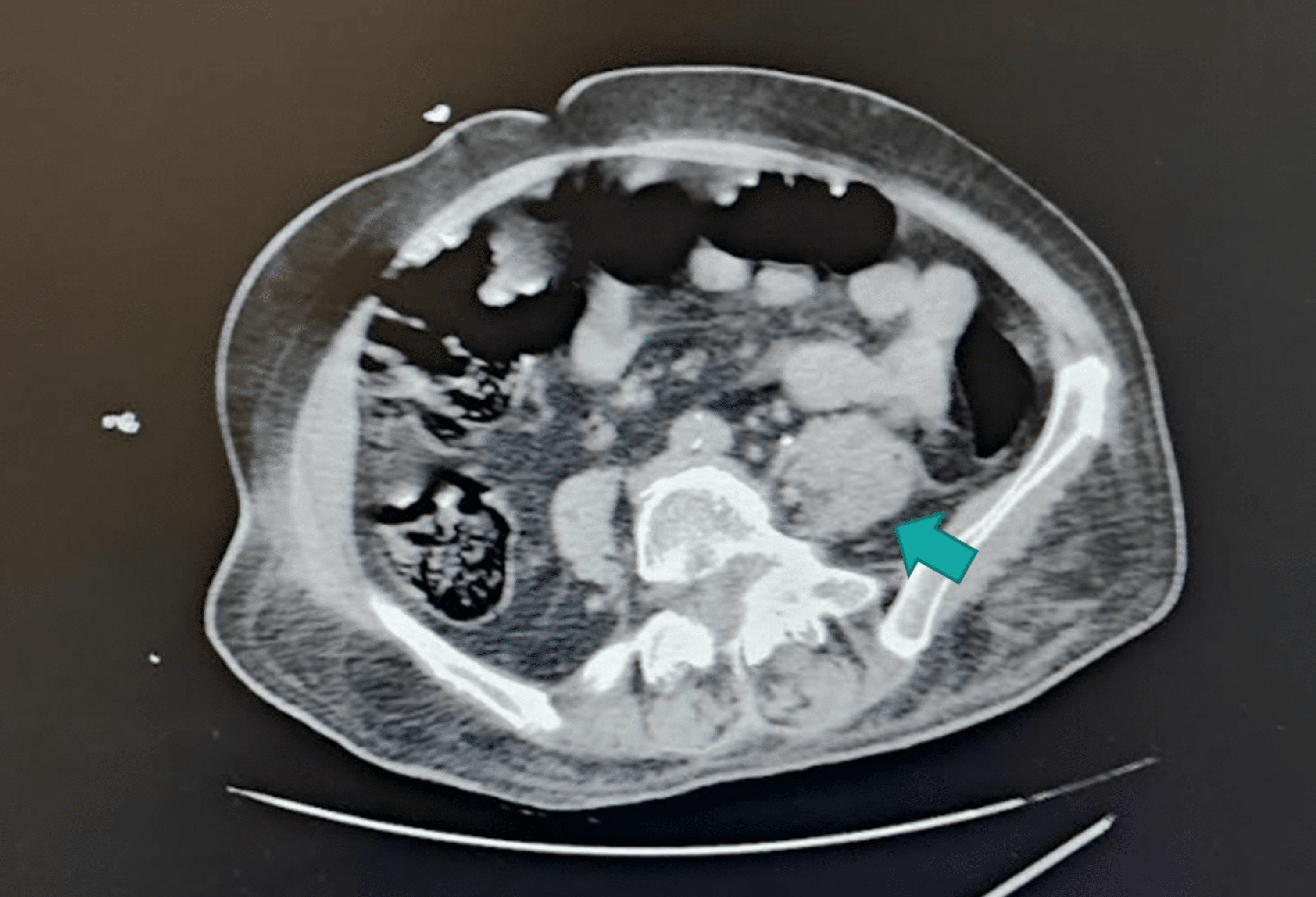 Psoas Abscess and Pott’s Disease Masked by Invasive