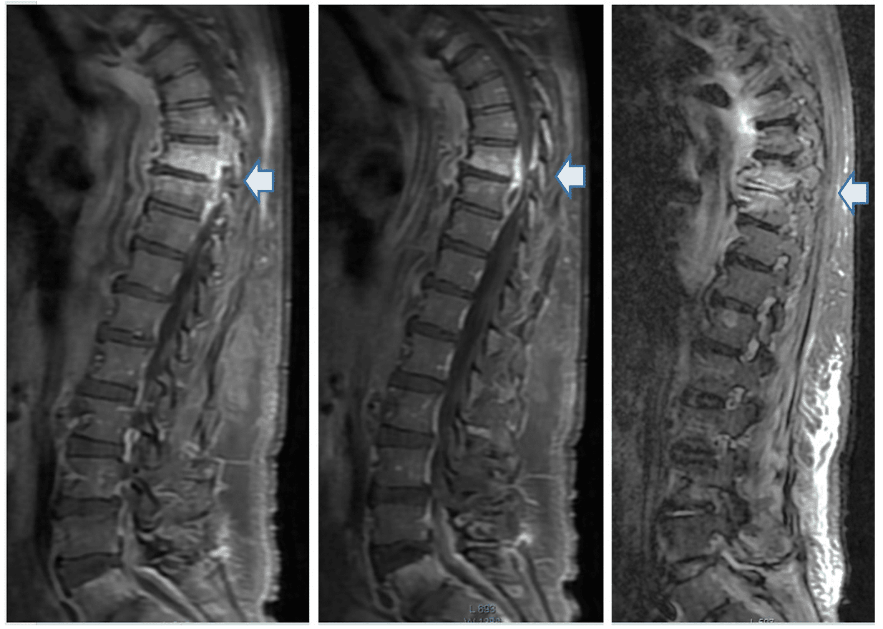 Cureus Psoas Abscess and Pott’s Disease Masked by Invasive Staphylococcus aureus
