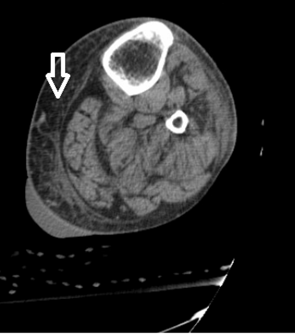 cureus-streptococcal-bacteremia-and-toxic-shock-syndrome-a-rare