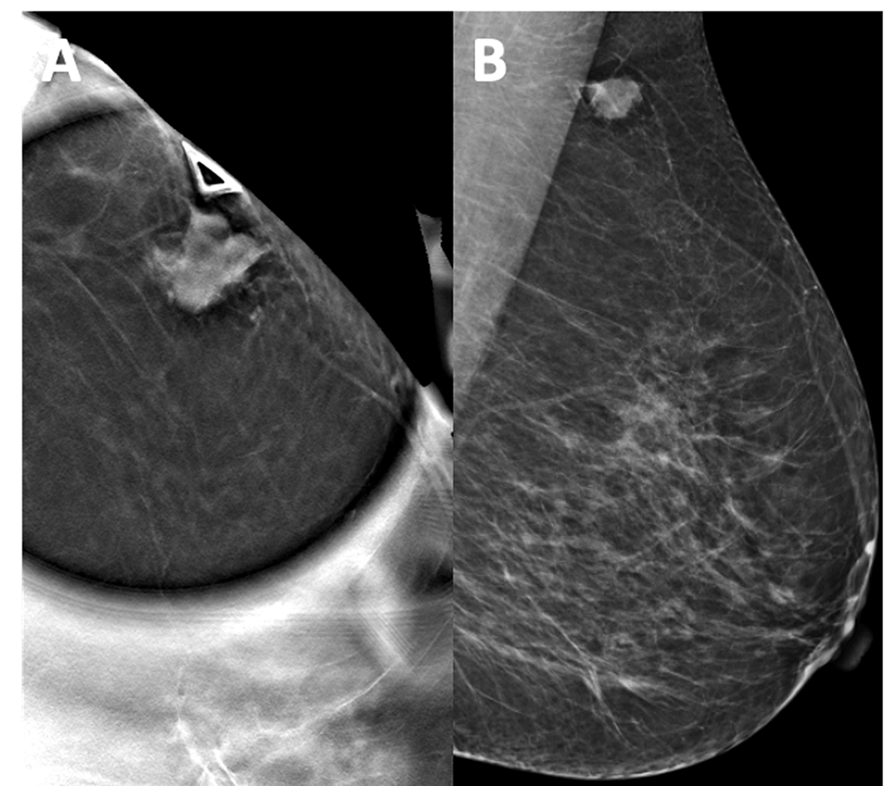 Rare Lymphoma of the Breast: A Case Report | Cureus