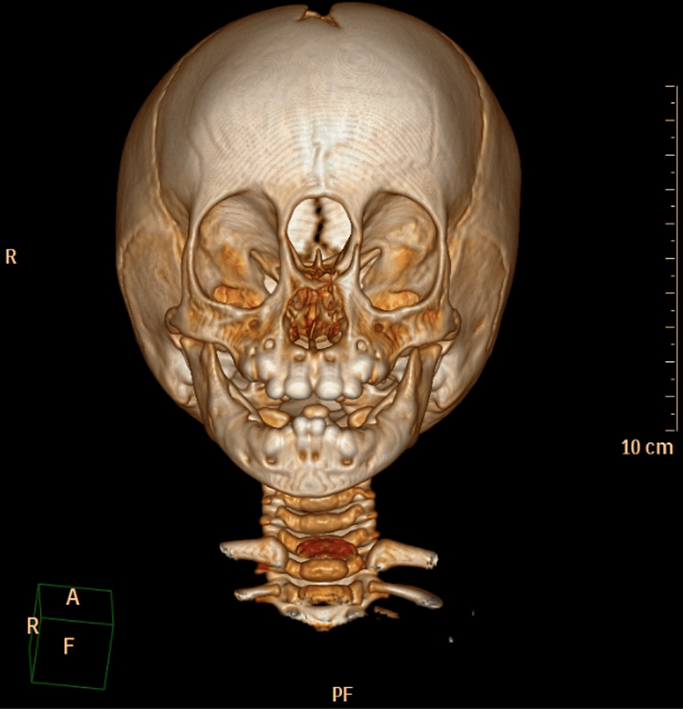 Cureus | airway management of a patient with a giant frontoethmoidal