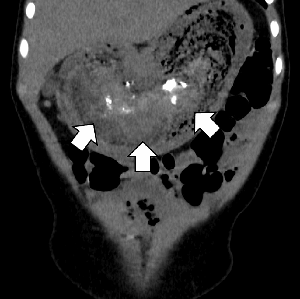 Trans umbilical Intragastric Surgery Using Two Alexis Wound Retractors carbon-monoxide-poisoning-sends-49-people-to-hospital-from-utah-church