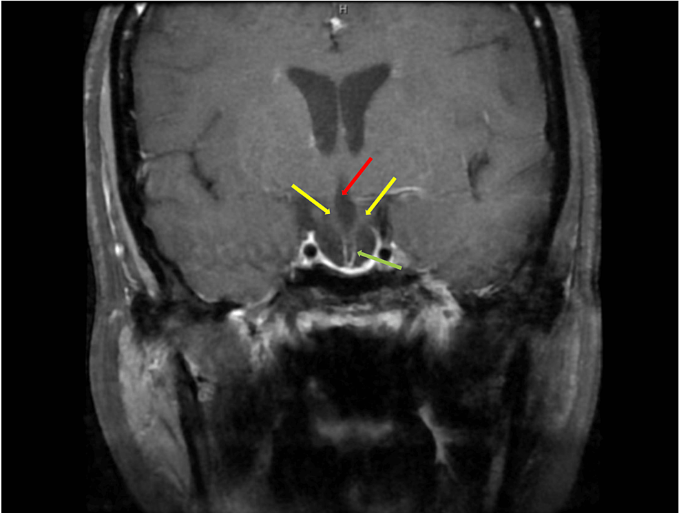 Severe Hyponatremia In A 46 Year Old Female With Pituitary Stalk Duplication And Primary Empty 7935