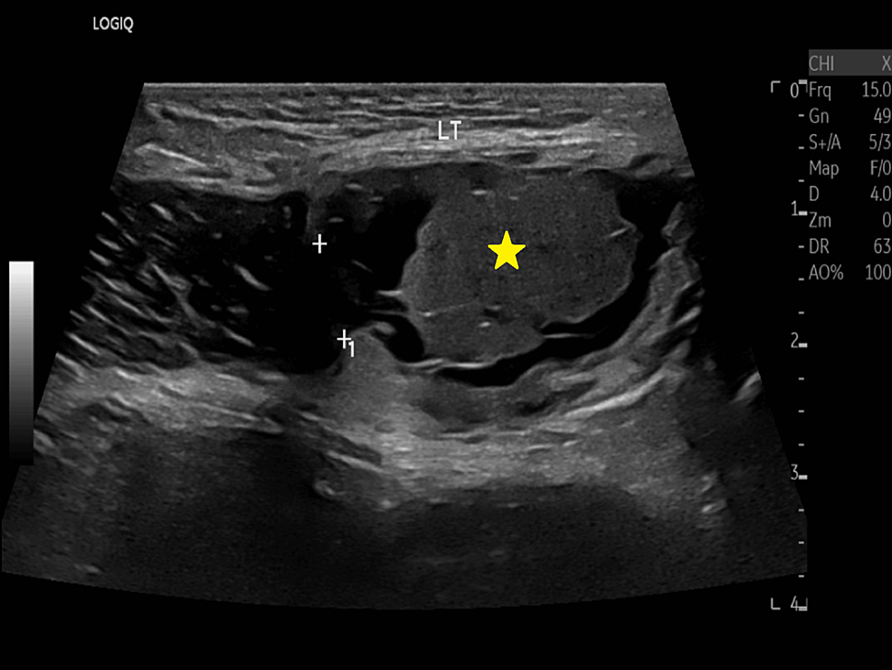Cureus  A Case of Hemorrhagic Ovarian Cyst Rupture Necessitating