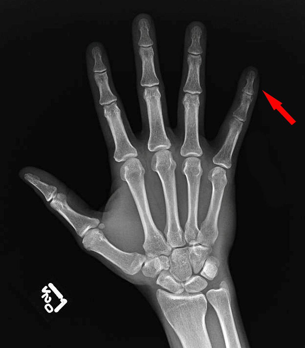 Cureus | Complex Focal Pain Syndrome: An Unusual Variant of Complex ...